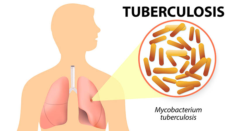 Tuberculosis: el 84% de los casos se diagnosticaron en la población de entre 20 a 44 años